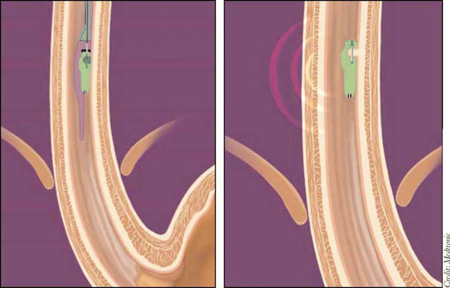 Figure. The physician inserts the capsule orally or transanally into the esophagus during upper endoscopy and pins it to the esophageal tissues (left). The capsule then transmits data via radio frequency telemetry to the receiver.