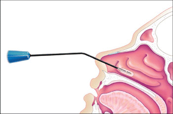 Figure. In coblation, the probe is inserted into the turbinate and vaporizes tissue within 0.5 mm of the probe surface with radiofrequency current.