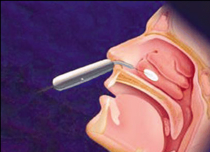 Figure. Radiofrequency volumetric tissue reduction (somnoplasty) creates a lesion in the meaty part of the turbinate and causes necrosis or coagulation of the tissue, shrinking it from the inside.