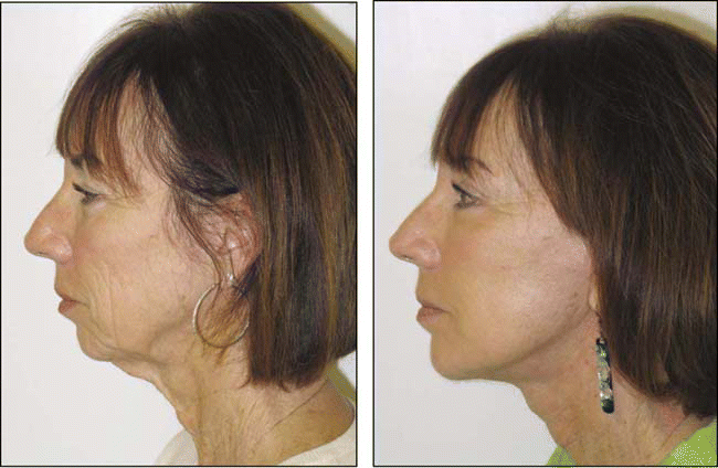 Figure. Before (left) and after (right) pictures of a patient who had an Extended Facial Lipo-Lift performed by Dr. Morganroth.