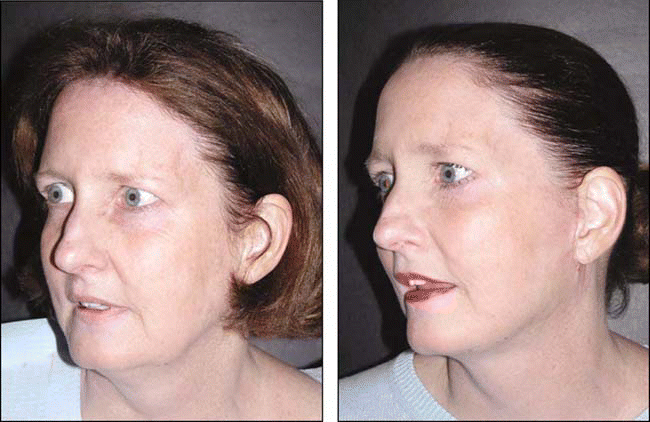 Figure. Before (left) and after (right) pictures of a patient who had a Tuliplift performed by Dr. Rahimi.