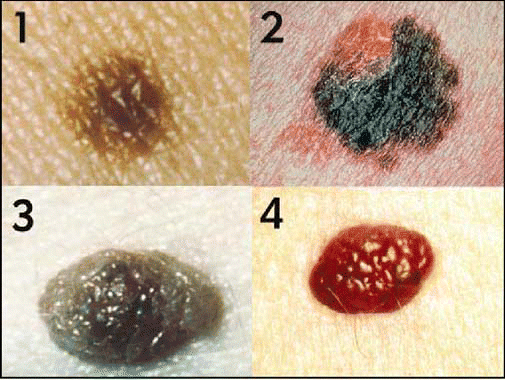 raised melanoma