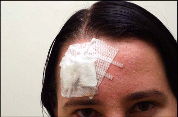 Figure. For optimal results, incisions should be placed along relaxed skin tension lines or at the boundary of facial subunits where there will be the least amount of pull on the scar and the best scar camouflage; for example, the orientation of an incision on the forehead would be along the horizontal lines.