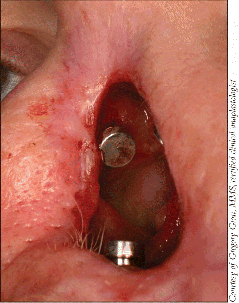 Figure. BEFORE: Nasal defect prepared with osteointegrated implants to accept prosthesis.