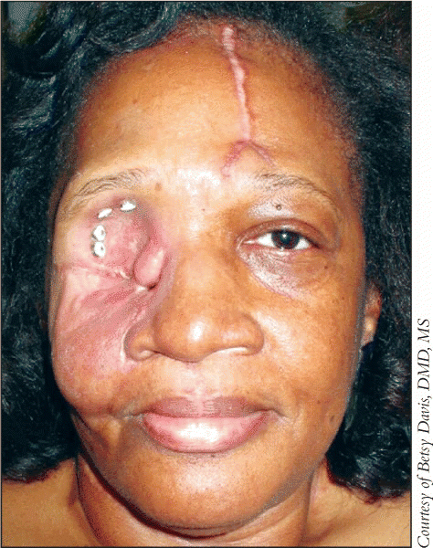 cancer in eye