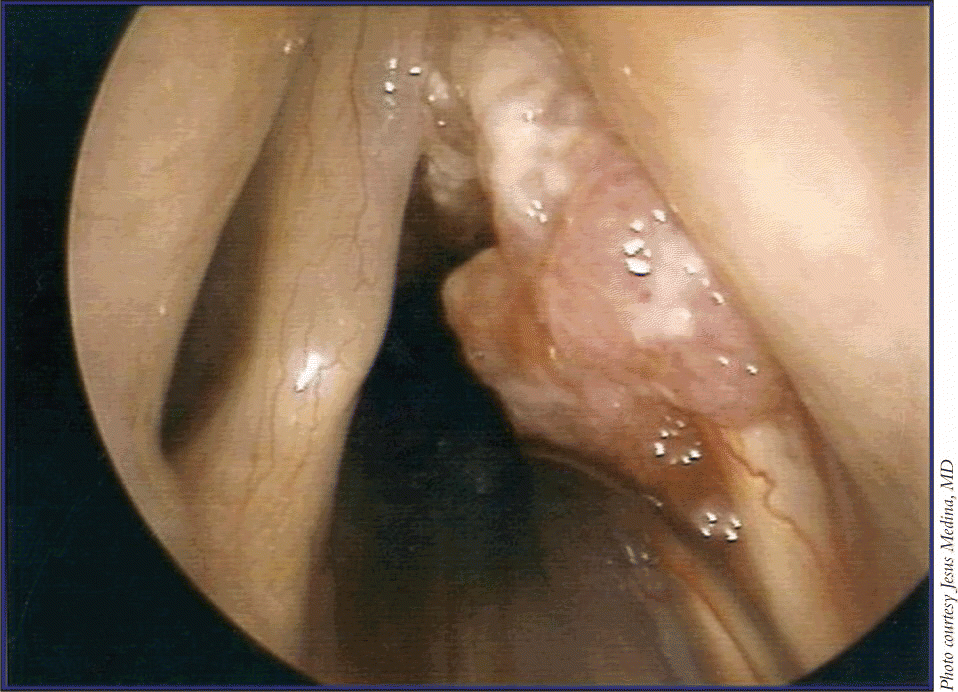 Figure 2. A 67-year-old man had a lesion that involved the anterior two-thirds of the vocal cord and extended up to the anterior commissure. There were about 9 to 10 mm of subglottic extension.
