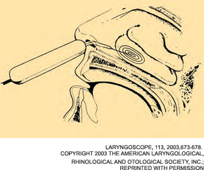 Sagittal view of radiofrequency energy being delivered. The active 10-mm portion of the electrode and at least 2 mm of the insulation are inserted submucosally within the anterior portion of the inferior turbinate and an ovoid lesion is created.