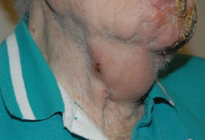 Figure 1. Right neck subdermal plaques with focal overlying ulceration.