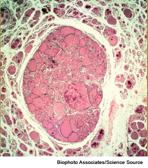 Light micrograph of a section through a thyroid gland with a colloid adenoma.