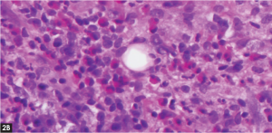 (click for larger image) Figure 2. (A) Punch biopsy of the left neck lesion with thickened stratum corneum and leukocytosis. (B) High powered field showing extensive eosinophilic infiltrate.