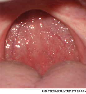 It’s important to determine which subgroup of sleep apnea patients would benefit from UPPP.