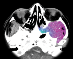 Salvage Surgery in Head and Neck Cancers