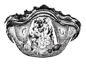 Myxoma of the larynx.