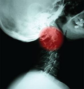 Prior treatment of the head and neck might influence the effectiveness of future postoperative radiation.