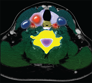 Color-enhanced cross sectional CT image of the neck showing a nodule (large round red density) in the right lobe of the thyroid gland (purple). 
