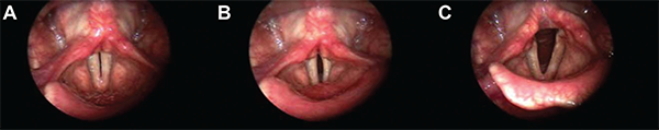 Series of vocal fold images displaying reduced right-sided kinesis. The left vocal fold showed increased excursion with greater movement than the right.