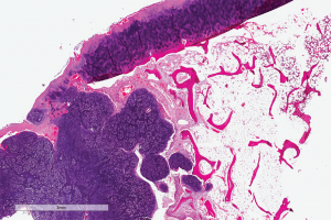 Digital slide depicting a whole-slide image of synovial chondromatosis, a lesion that sometimes involves the temporomandibular joint. Courtesy of the Center for ePathology, Cleveland Clinic.