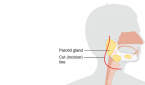 Benefits, Drawbacks of Free Abdominal Fat Transfer for Parotidectomy Defect Reconstruction