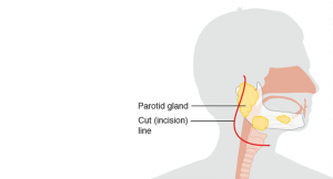 Benefits, Drawbacks of Free Abdominal Fat Transfer for Parotidectomy Defect Reconstruction