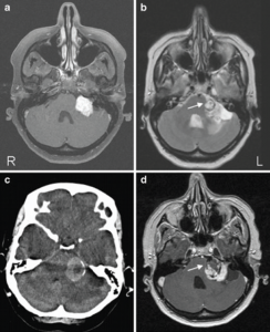 Caption: A) Axial T1-weighted MRI with gadolinium contrast enhancement showing left-sided vestibular schwannoma (VS). B) Axial T2-weighted MRI of the posterior fossa showing round lesion inside the VS (arrow) with surrounding hemosiderin deposits. C) Axial CT image through the posterior fossa showing a hyperdens area due to intratumoral hemorrhage in the VS. D) Axial T1-weighted postcontrast MRI showing hemorrhage (hypo-intense area) inside lesion (arrow). The VS enhances homogeneous and contrast-sparing occurs at the location of the hematoma (R right, L left).