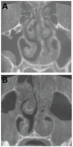 KA) Coronal plane of a CBCT scan from a patient three days after onset of symptoms. Haller cell and concha bullosa are present on the right side, and a cyst is present in the right maxillary sinus. The nasal septum is deviated to the left (19.4°). Both osteomeatal complexes are open, and other paranasal sinus mucosal abnormalities are not present. (B) Coronal plane of a CBCT scan from a patient nine days after onset of symptoms. There are air-liquid levels in the left maxillary sinus and gas bubbles in the right. The patient underwent maxillary sinus aspiration, which was cultured for Haemophilus influenzae.