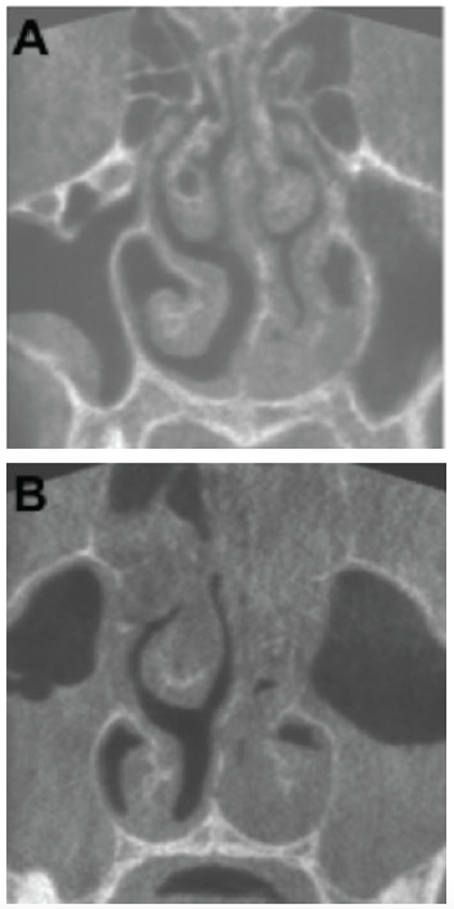 KA) Coronal plane of a CBCT scan from a patient three days after onset of symptoms. Haller cell and concha bullosa are present on the right side, and a cyst is present in the right maxillary sinus. The nasal septum is deviated to the left (19.4°). Both osteomeatal complexes are open, and other paranasal sinus mucosal abnormalities are not present. (B) Coronal plane of a CBCT scan from a patient nine days after onset of symptoms. There are air-liquid levels in the left maxillary sinus and gas bubbles in the right. The patient underwent maxillary sinus aspiration, which was cultured for Haemophilus influenzae.