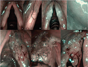 Examples of different Ni classification types applied in studied group of patients. Type I: thin, interconnected vessels. Type II: enlarged vessel diameter. Type III: vascular patterns obscured by white mist. Type IV: small regularly distributed dots. Type Va: solid or hollow thick brown spots with various shapes. Type Vb: destroyed loop, its remnants are visible as line-like shapes. Type Vc: combination of type Va and Vb, irregular distribution.