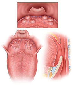 LTH Grade 1: Lymphoid tissue scattered over tongue, does not cover entire surface of tongue base.