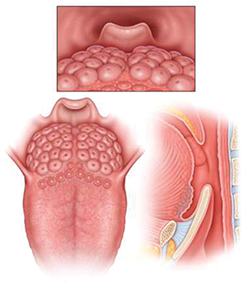 LTH Grade 2: Lymphoid tissue covering entire tongue base, limited vertical thickness.