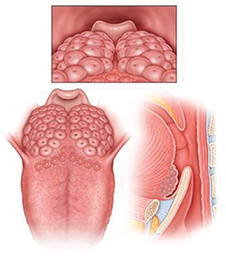 LTH Grade 3: Lymphoid tissue covering entire tongue base, vertical thickness between 5-10 mm, approximately 25-75% of height of epiglottis.