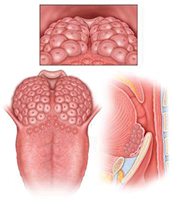 LTH Grade 4: Lymphoid tissue covering entire tongue base, vertical thickness approximately 1 cm, rises above tip of epiglottis.