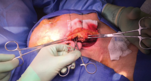 Experts Offer Tips, Insights on Common Head and Neck Surgical Procedures