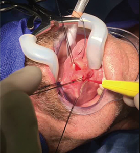 “Geppetto” technique for partial glossectomy.