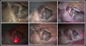 Photos of specimens implanted with different adjustable ossicular replacement prostheses. Clockwise from upper left: intact, adjustable partial ossicular replacement prosthesis (A-PORP), PORP, incus PORP, adjustable total ossicular replacement prosthesis, A-PORP under laser Doppler vibrometry.