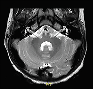 Asymmetric enlargement of the vestibular aqueduct (on right).