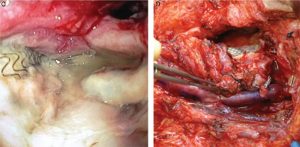 Figure 1. (C) Direct pharyngoscopy showing exposed covered stent in the pharynx. (D) Definitive vascular reconstruction of the left carotid artery with superficial femoral vein graft. Credit: Copyright 2016 The American Laryngological, Rhinological and Otological Society, Inc.