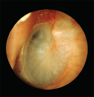 Endoscopic view of the tympanic membrane.