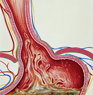 Gastroesophageal reflux.