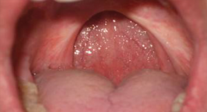 Patient following a uvulopalatopharyngoplasty.