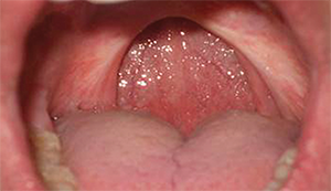 Patient following a uvulopalatopharyngoplasty.