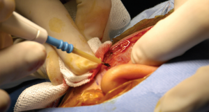 Cochlear implant surgery.