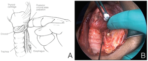 Figure 1. A) Laryngeal twitch can be palpated with a finger placed on the posterior aspect of the larynx during recurrent laryngeal nerve (RLN) or vagal stimulation. B) Stimulator probe points to the left RLN in the photo. Credit: Copyright 2016 The American Laryngological, Rhinological and Otological Society, Inc.