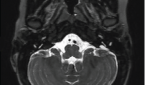 Deafness from enlarged vestibular aqueduct see on an MRI.