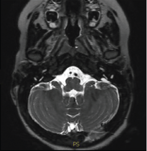 Deafness from enlarged vestibular aqueduct see on an MRI.