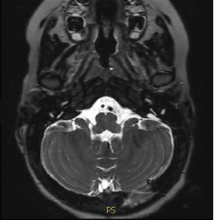 Deafness from enlarged vestibular aqueduct see on an MRI.