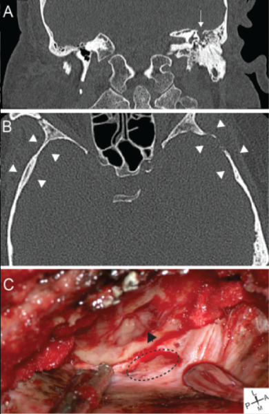Figure 2: Representative images from a patient with a lateral sCSF leak. (A) Representative coronal CT showing left tegmen mastoideum defect (arrow) with fluid in the middle ear and mastoid. (B) Axial CT demonstrating cortical skull thinning (arrowheads). (C) Intraoperative images showing tegmen defect with encephalocele (arrowhead) and dural defect (dotted line). Copyright 2017 The American Laryngological, Rhinological and Otological Society, Inc.