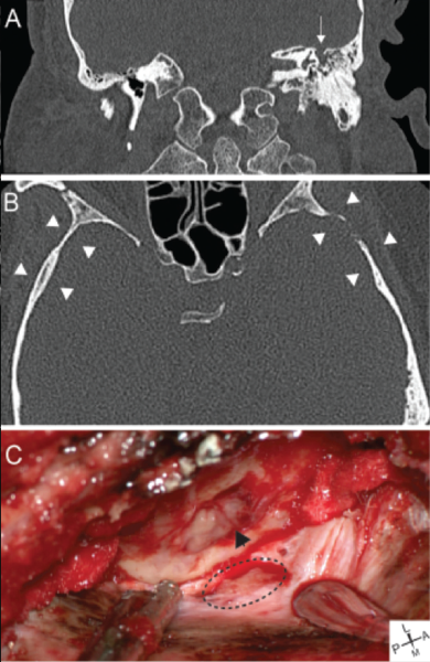 Leak cerebrospinal fluid Spinal Fluid