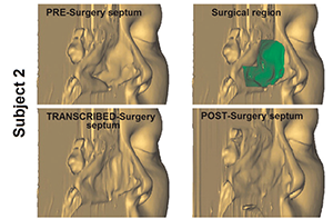 Figure 2. 3D transcribed-surgery model of the nasal septum.