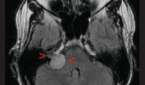 Vestibular schwannoma.