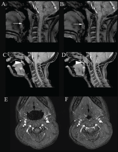Figure 1. Cine magnetic resonance imaging showing upper airway obstruction. Sagittal images demonstrate the open (A, C) and narrowed airway (B, D) at the level of the tongue base (white arrow) and velum (arrow head)/tongue base (*). Posterior displacement of the tongue also caused posterior displacement of the soft palate (A, B). Axial images show the open (E) and narrowed airway (F) at the level of oropharynx/lateral walls (>) and tongue base (black arrow). Imaging technique prevents presentation of an example of concurrent obstruction at the level of the velum/oropharynx/lateral walls/tongue base in a single image. Copyright 2017 The American Laryngological, Rhinological and Otological Society, Inc.